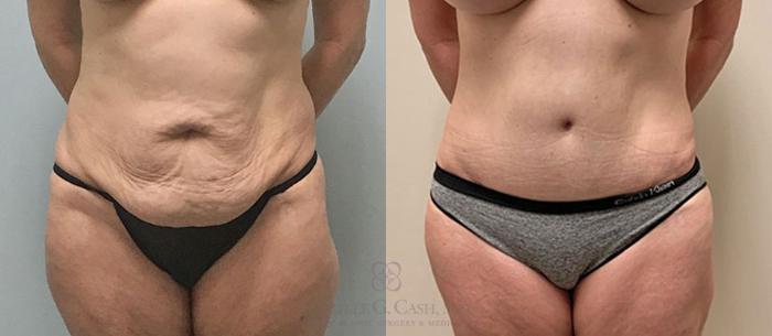 Before & After Tummy Tuck Case 313 View #1 View in Houston, TX