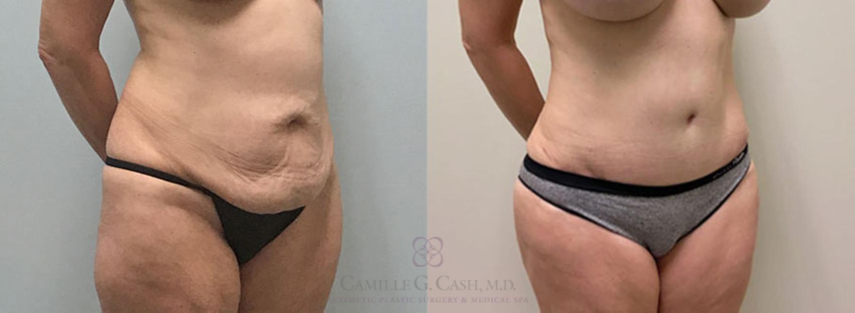 Before & After Tummy Tuck Case 313 View #2 View in Houston, TX