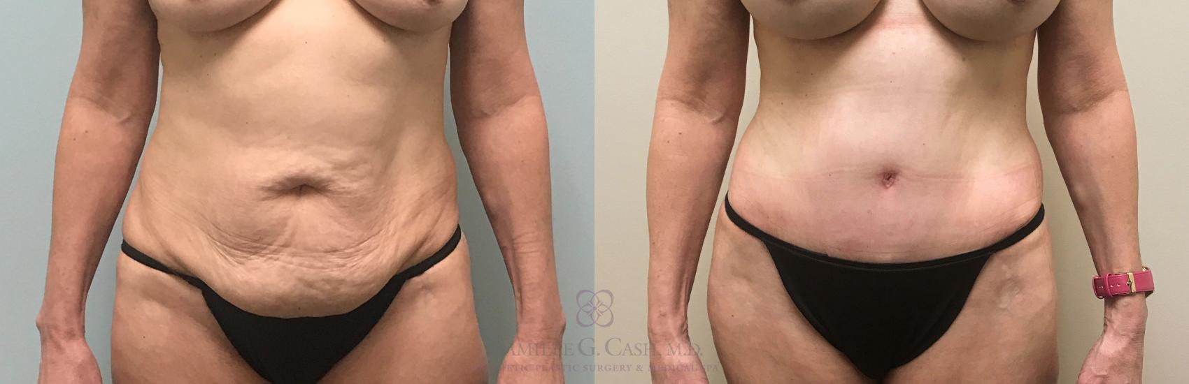 Before & After Tummy Tuck Case 313 View #3 View in Houston, TX