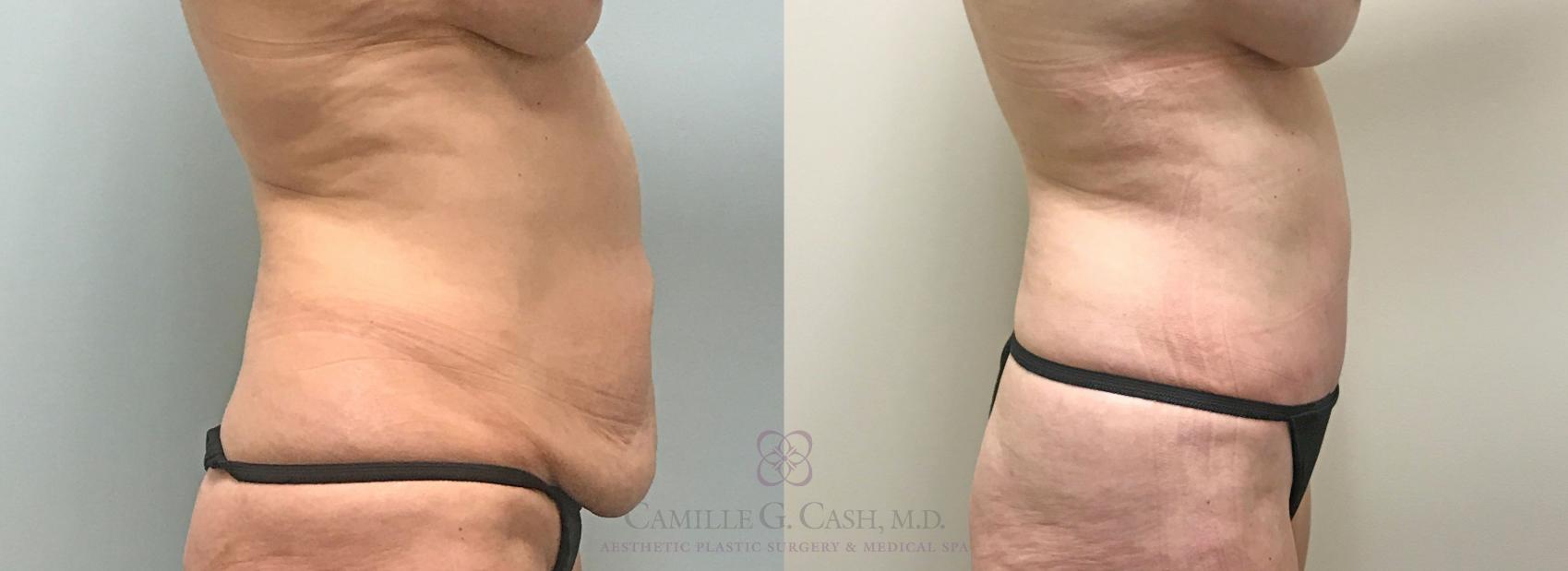 Before & After Tummy Tuck Case 313 View #4 View in Houston, TX