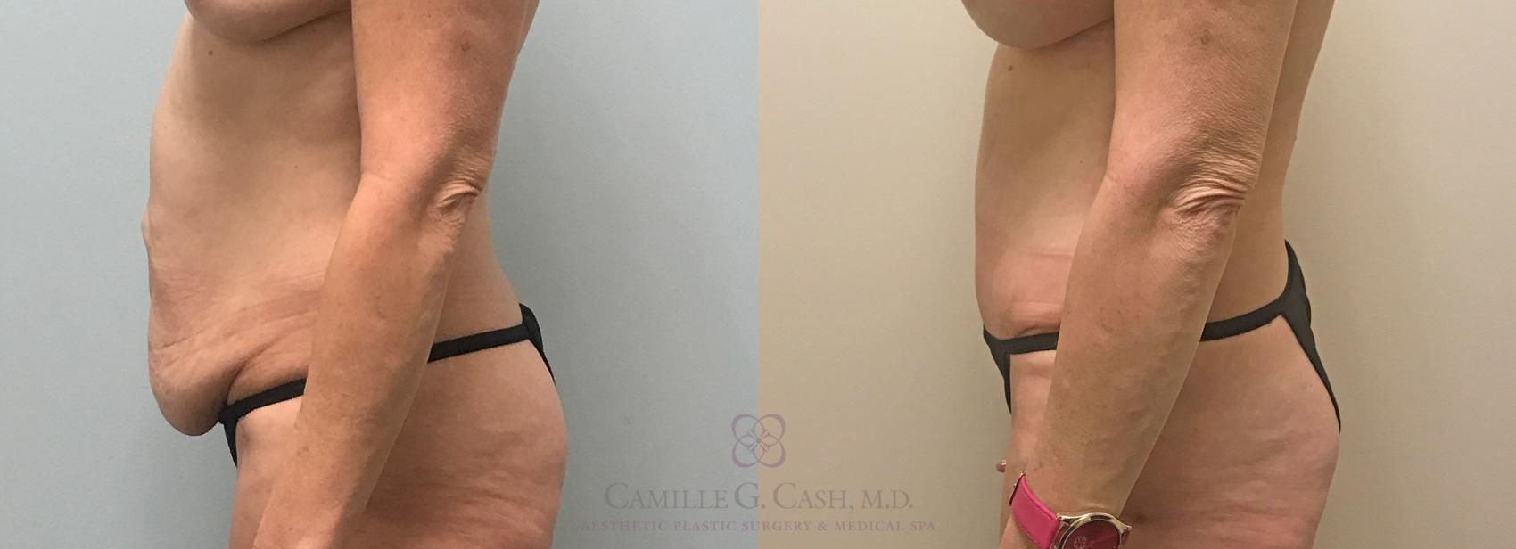 Before & After Tummy Tuck Case 313 View #5 View in Houston, TX