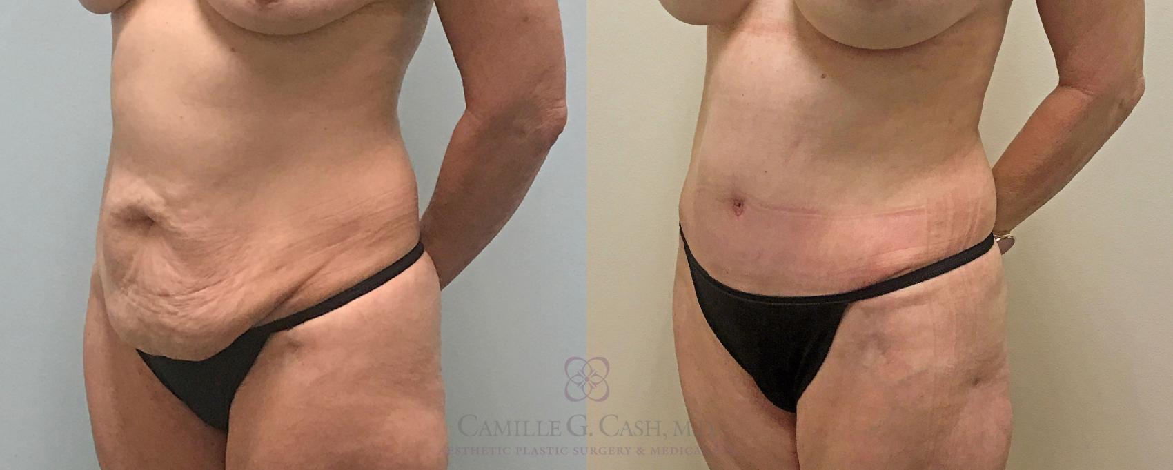 Before & After Tummy Tuck Case 313 View #6 View in Houston, TX