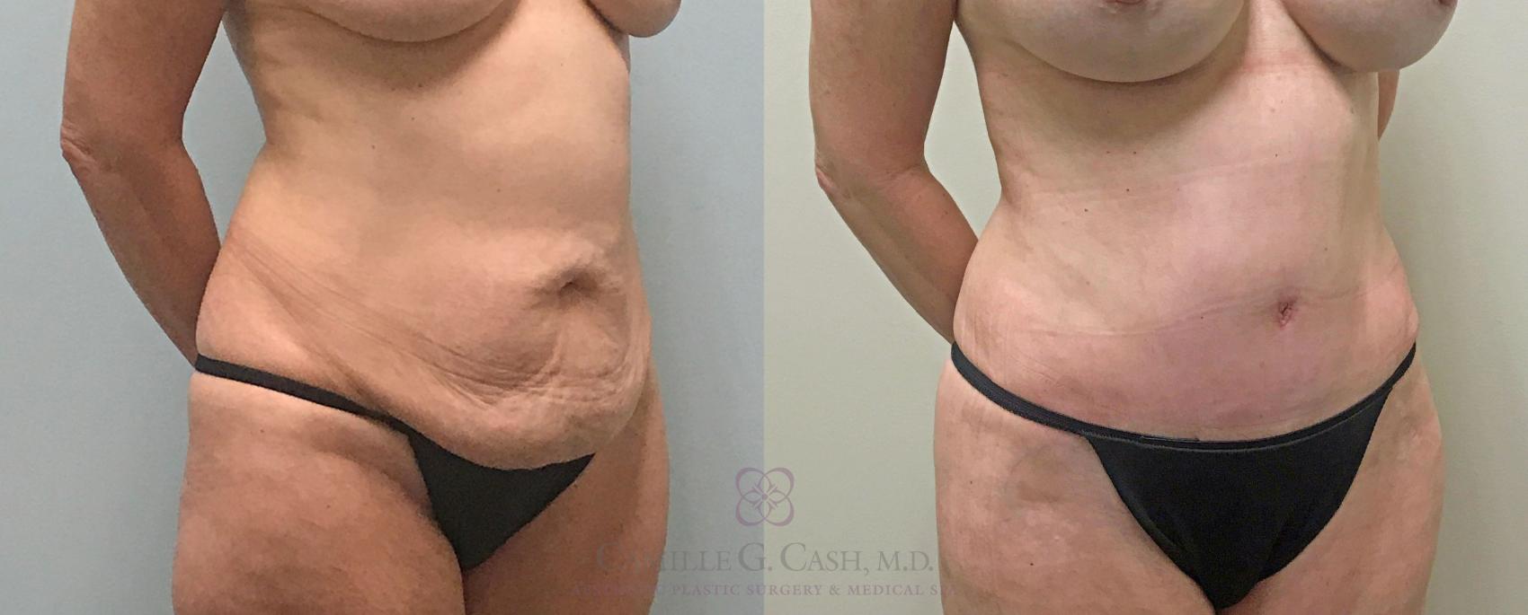Before & After Tummy Tuck Case 313 View #7 View in Houston, TX