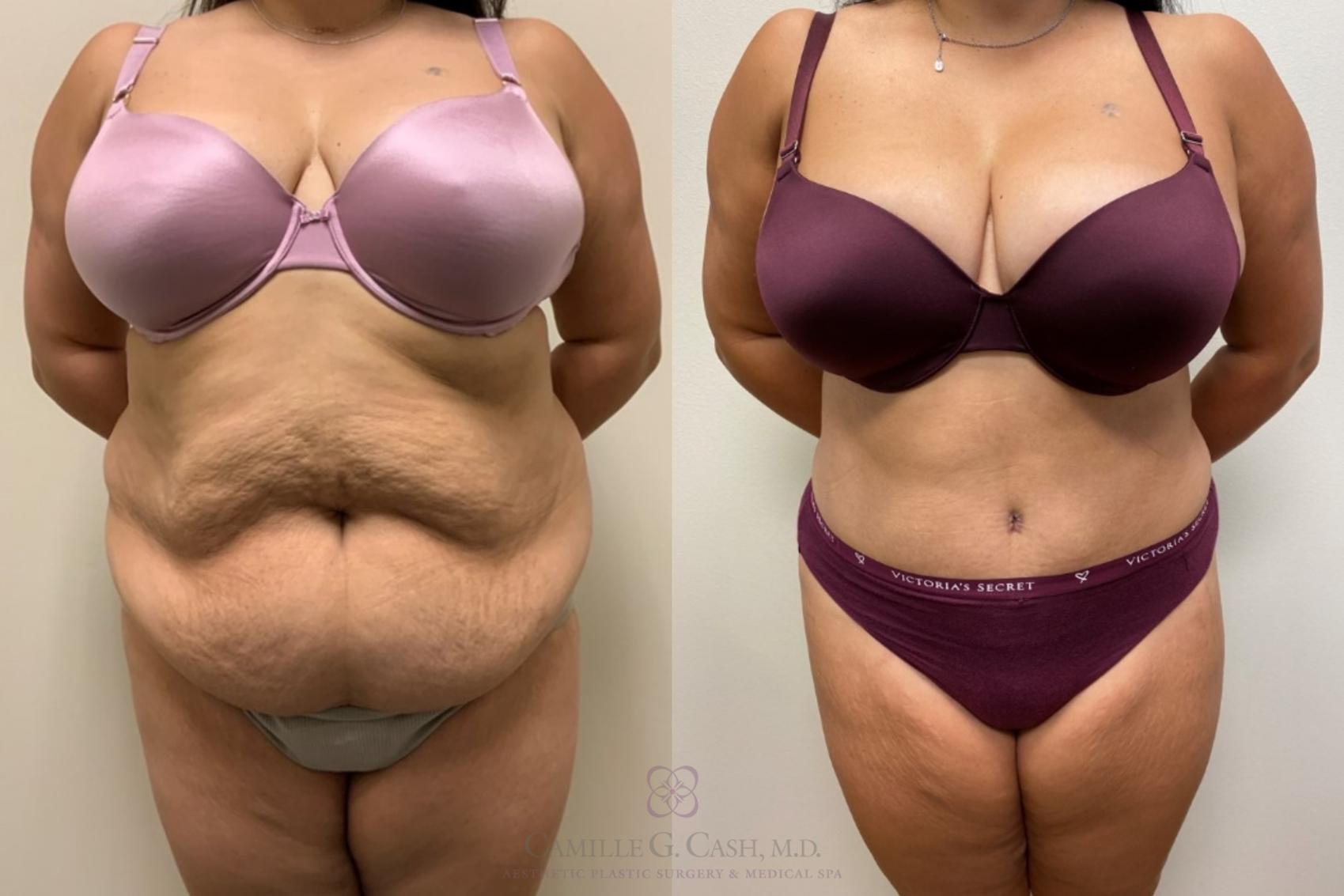 Before & After Tummy Tuck Case 345 front 5 View in Houston, TX