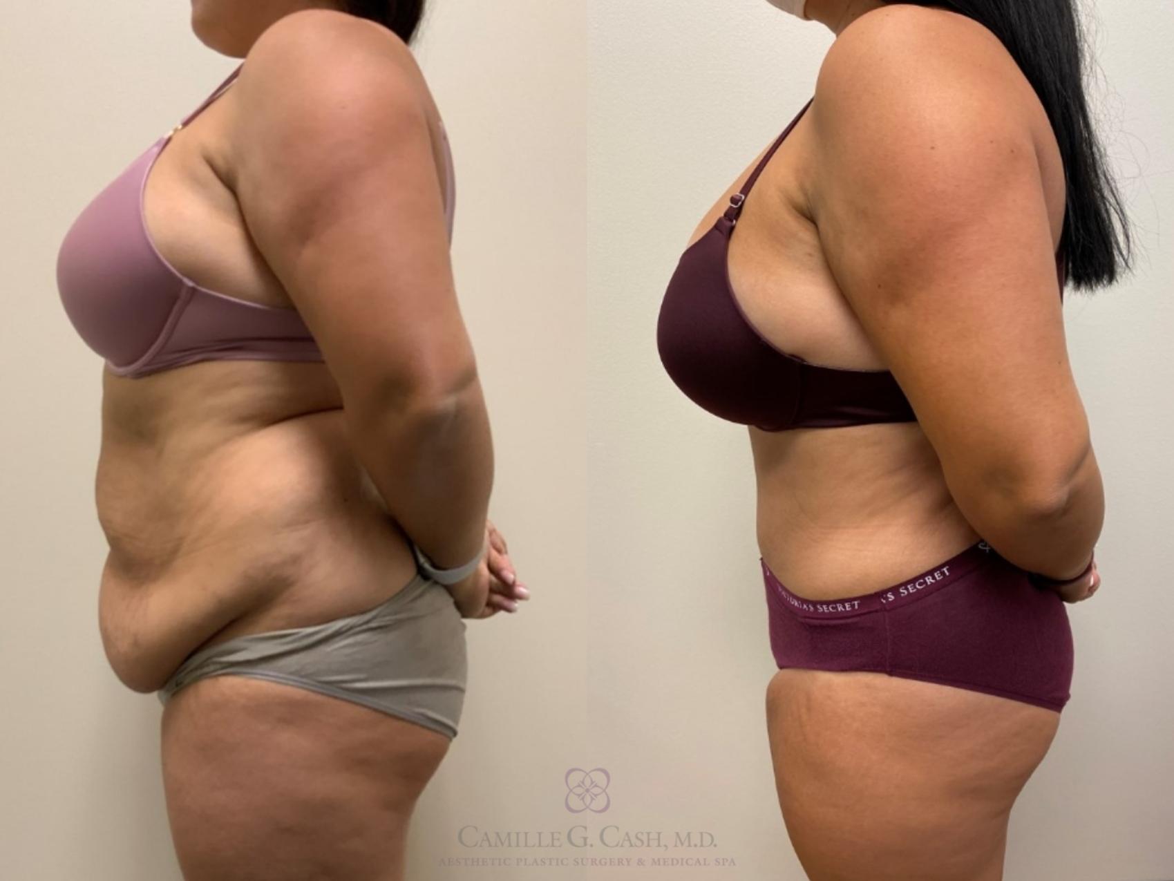 Before & After Tummy Tuck Case 345 left side 2 View in Houston, TX