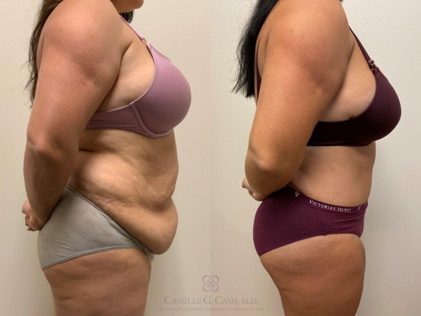 Before & After Tummy Tuck Case 345 right side 2 View in Houston, TX
