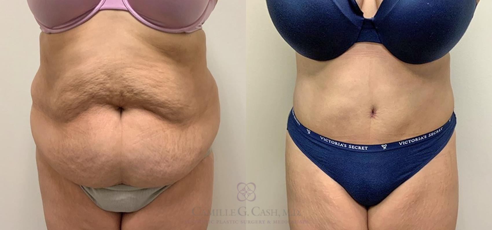 Before & After Tummy Tuck Case 345 View #1 View in Houston, TX