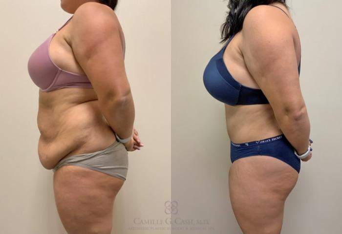 Before & After Tummy Tuck Case 345 View #4 View in Houston, TX
