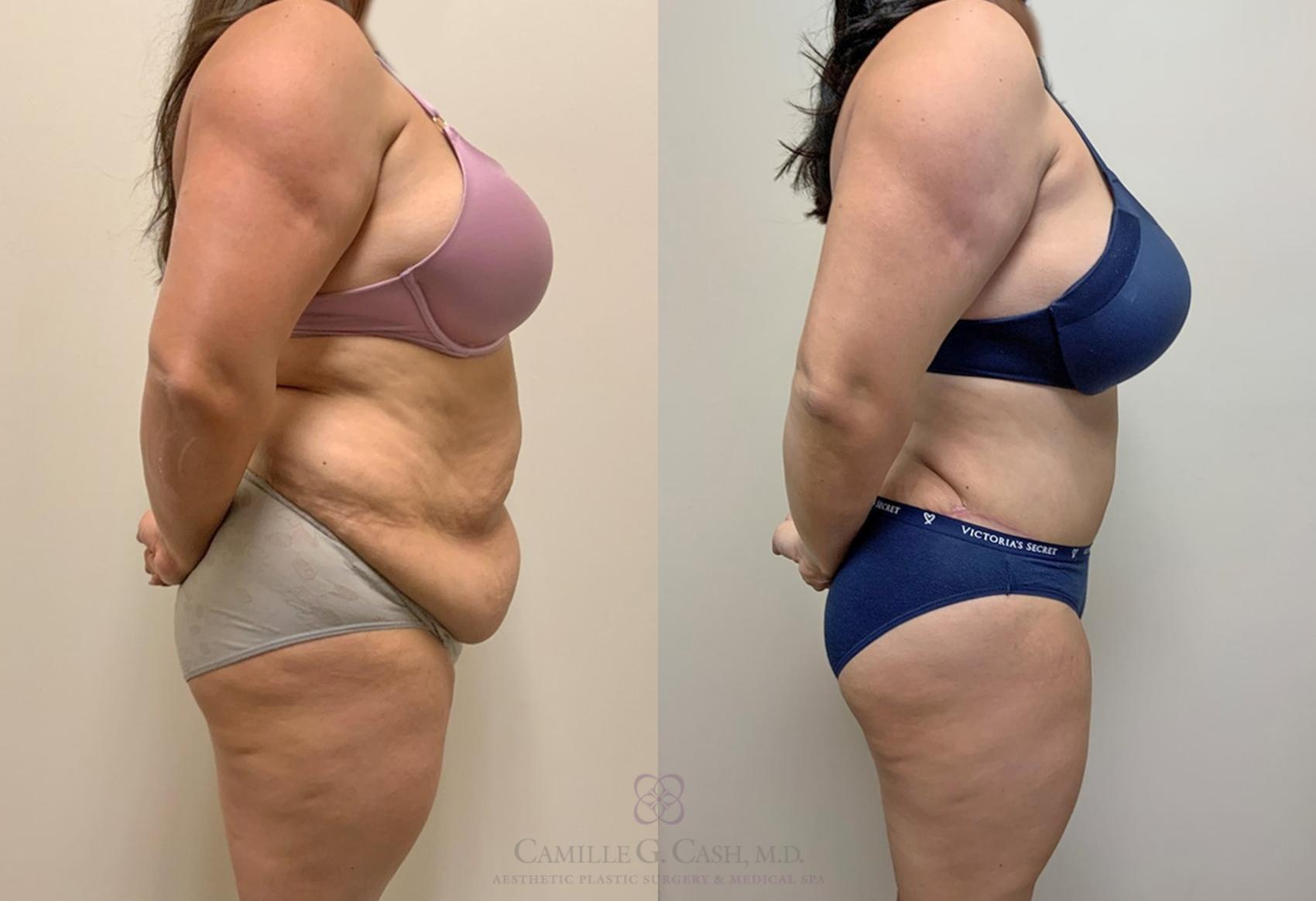 Before & After Tummy Tuck Case 345 View #5 View in Houston, TX