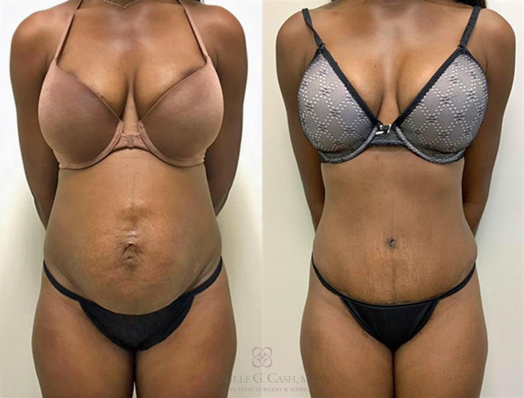 Before & After Tummy Tuck Case 359 View #1 View in Houston, TX