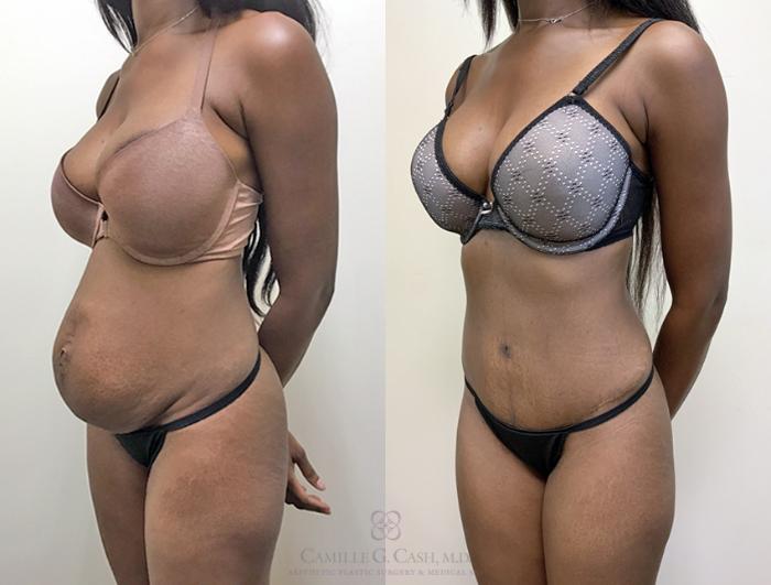 Before & After Tummy Tuck With Hernia Repair Case 359 View #2 View in Houston, TX