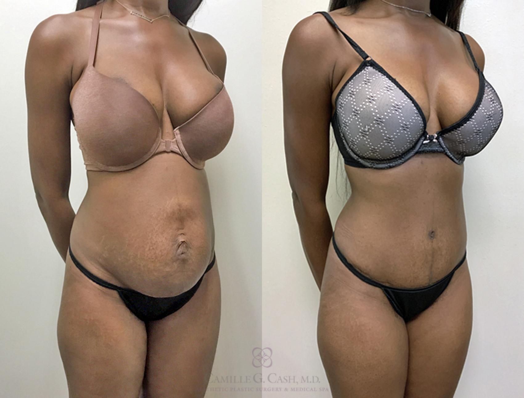 Before & After Tummy Tuck Case 359 View #3 View in Houston, TX