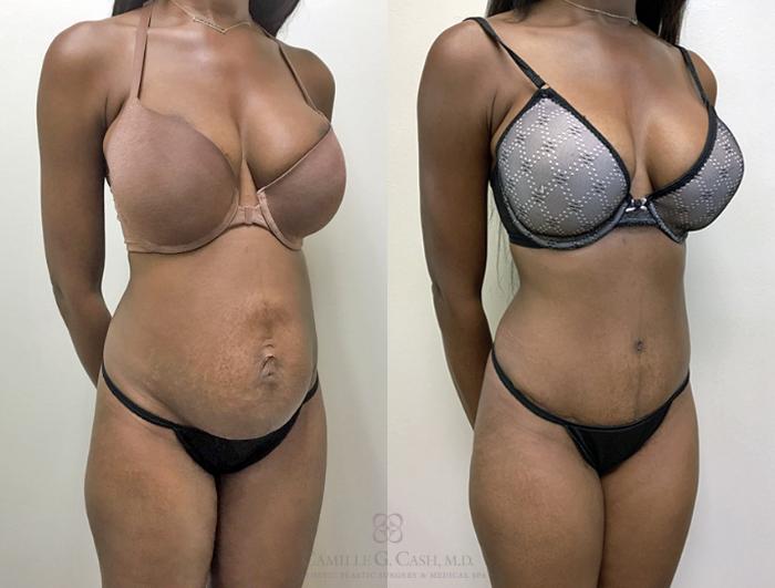 Before & After Tummy Tuck With Hernia Repair Case 359 View #3 View in Houston, TX