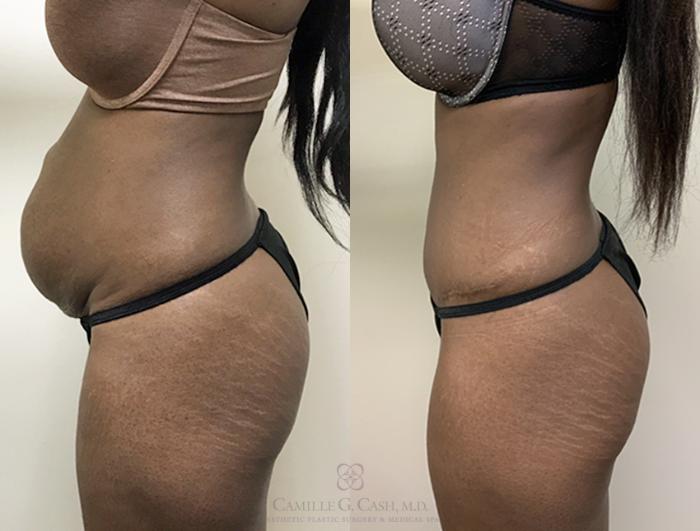 Before & After Tummy Tuck With Hernia Repair Case 359 View #4 View in Houston, TX