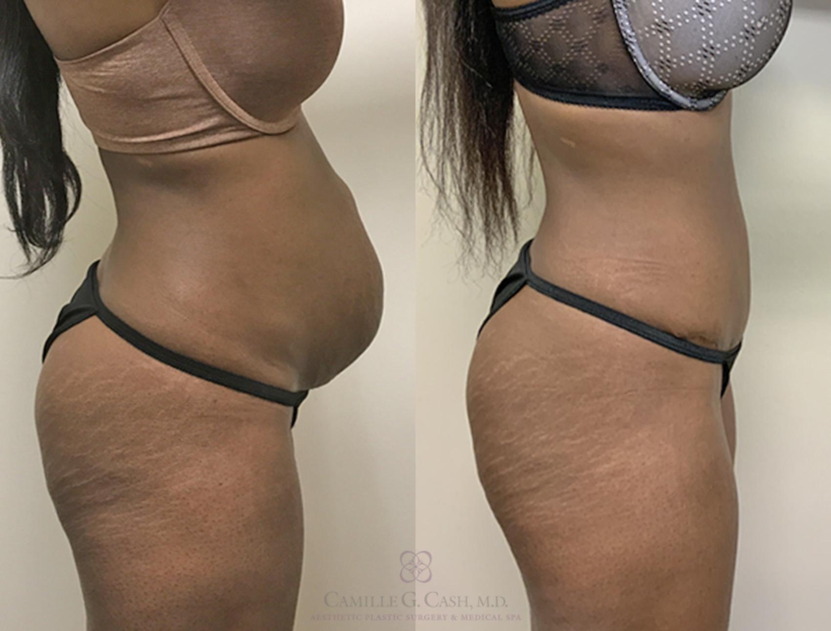 Before & After Tummy Tuck Case 359 View #5 View in Houston, TX