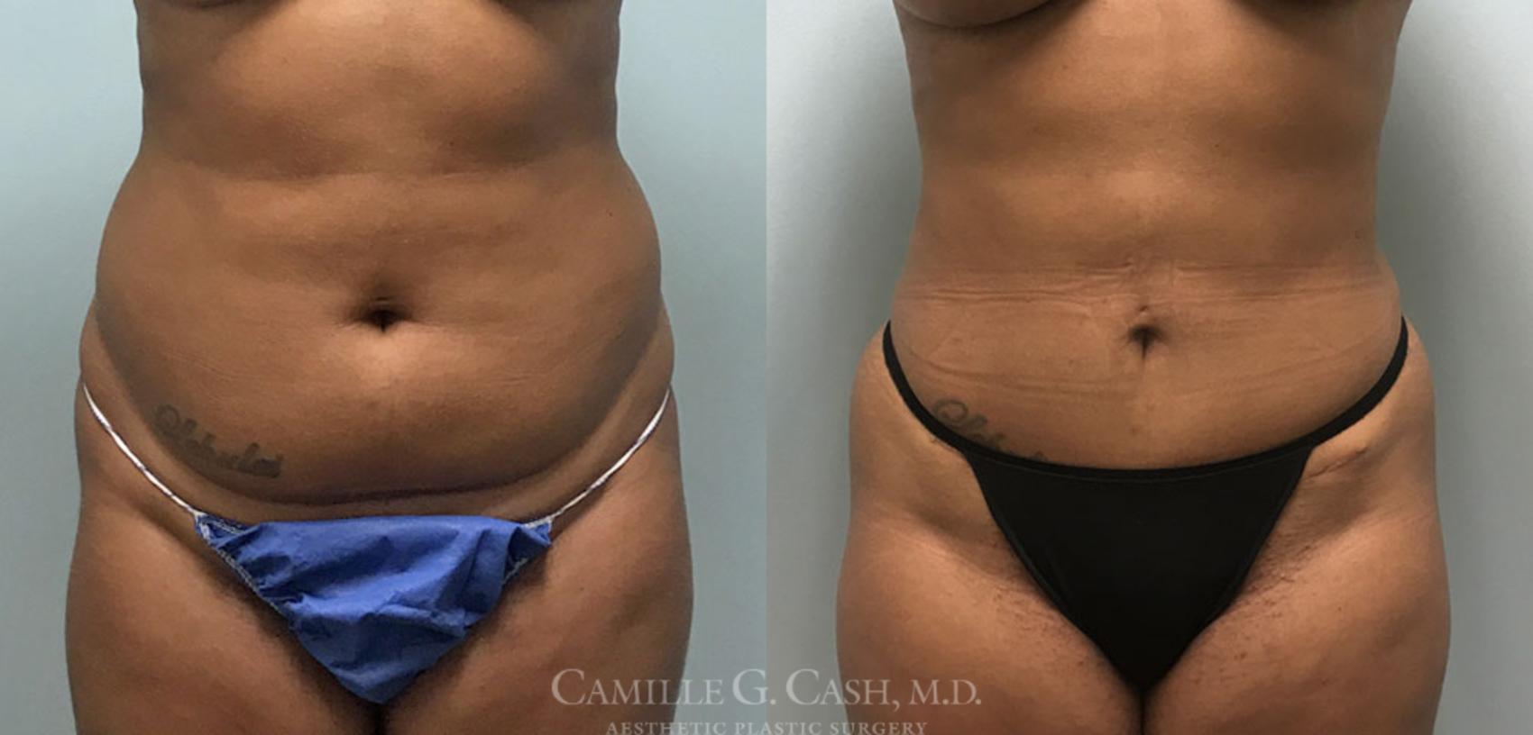Before & After Tummy Tuck Case 360 View #1 View in Houston, TX