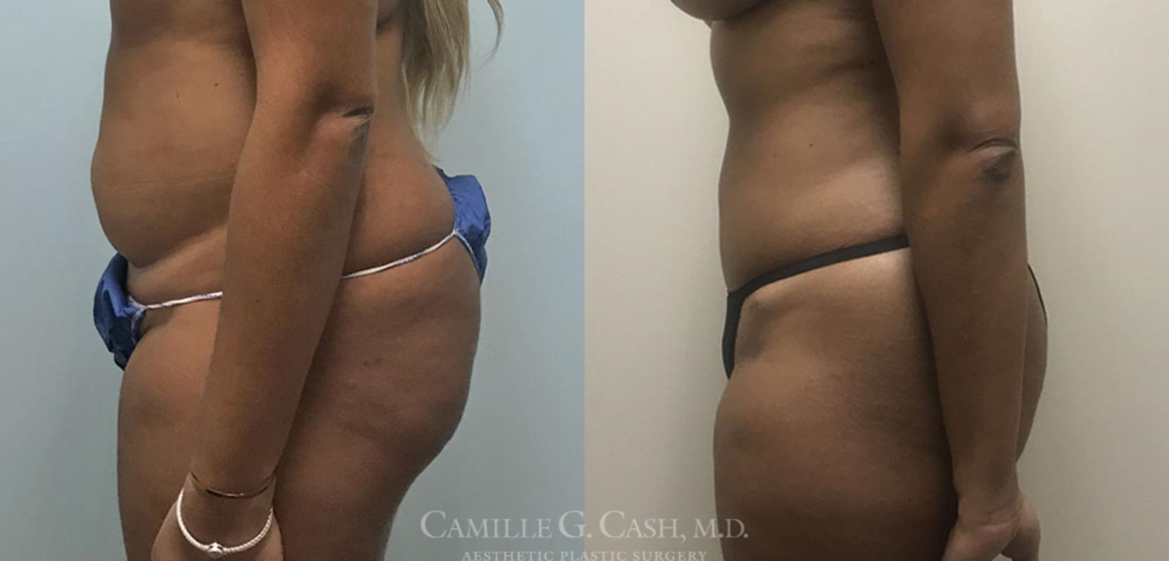 Before & After Tummy Tuck Case 360 View #4 View in Houston, TX