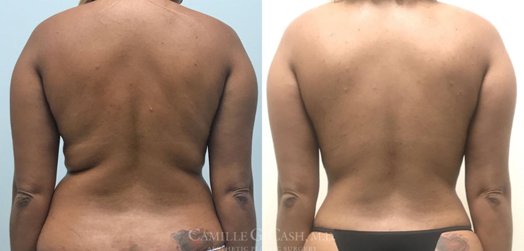 Before & After Tummy Tuck Case 360 View #5 View in Houston, TX
