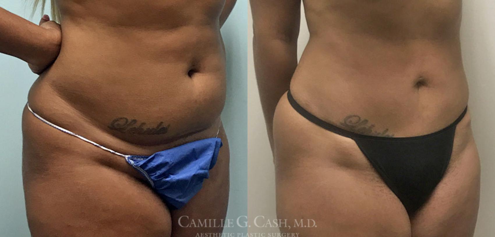 Before & After Tummy Tuck Case 360 View #6 View in Houston, TX