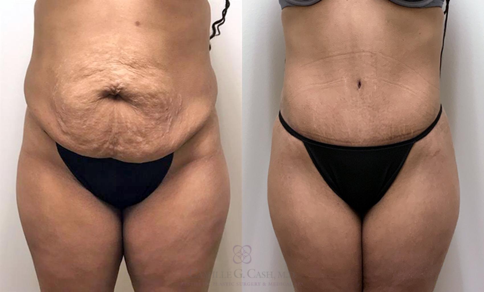 One of the Best Houston Tummy Tuck (Abdominoplasty) Doctors