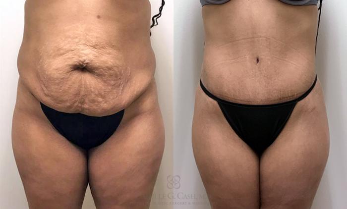 Tummy Tuck with liposuction of the flanks and iliac crest