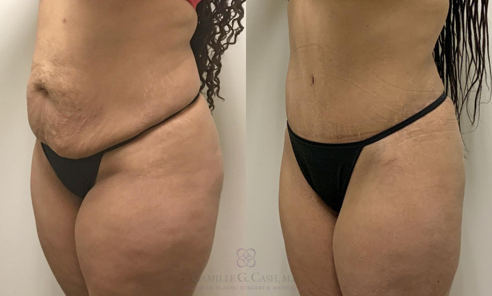 Before & After Tummy Tuck Case 363 View #2 View in Houston, TX