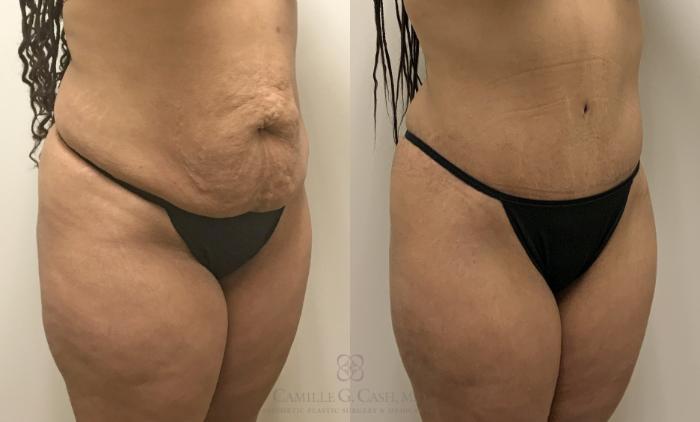 Before & After Tummy Tuck Case 363 View #3 View in Houston, TX