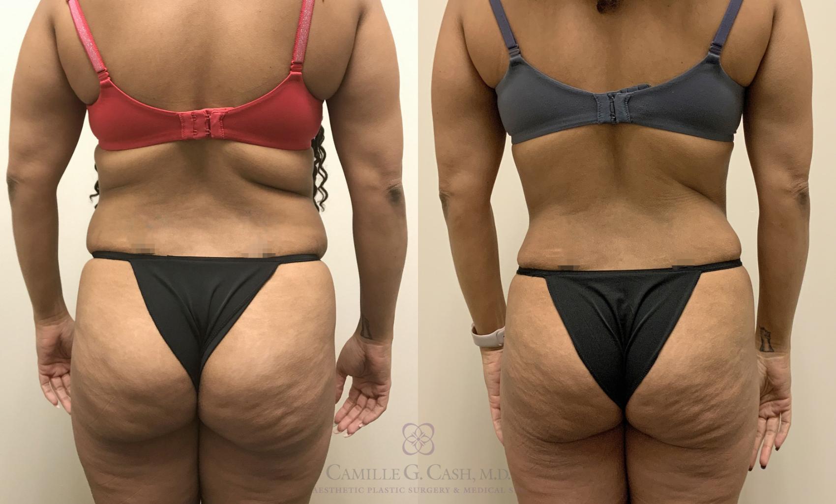Before & After Tummy Tuck Case 363 View #4 View in Houston, TX