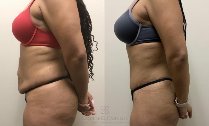 Before & After Tummy Tuck Case 363 View #5 View in Houston, TX