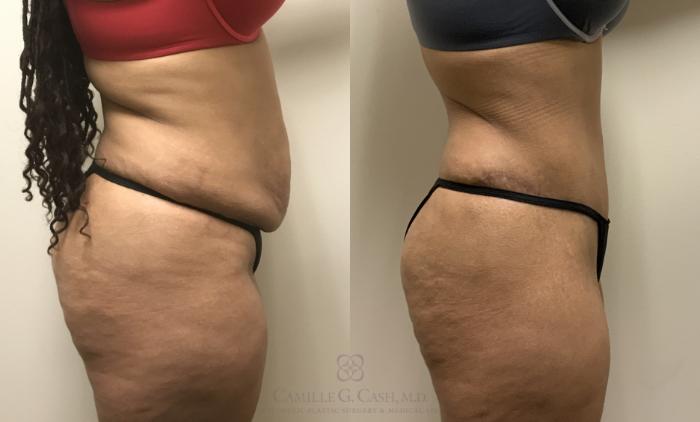 Tummy Tuck with liposuction of the flanks and iliac crest