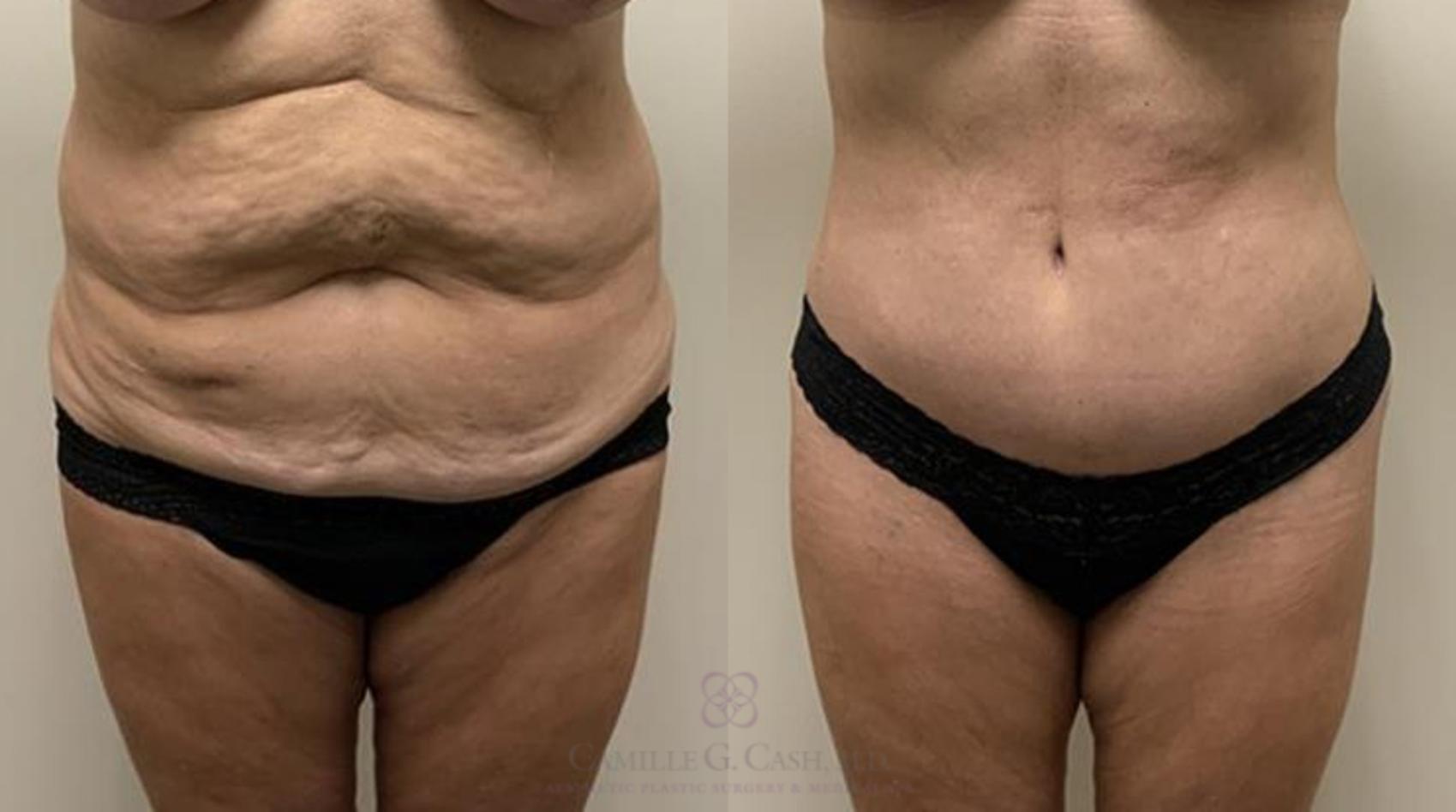 Before & After Tummy Tuck Case 364 View #1 View in Houston, TX