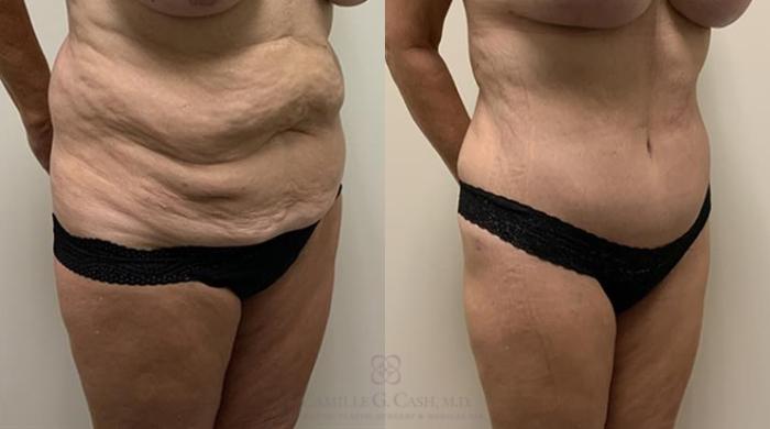 Before & After Tummy Tuck Case 364 View #2 View in Houston, TX