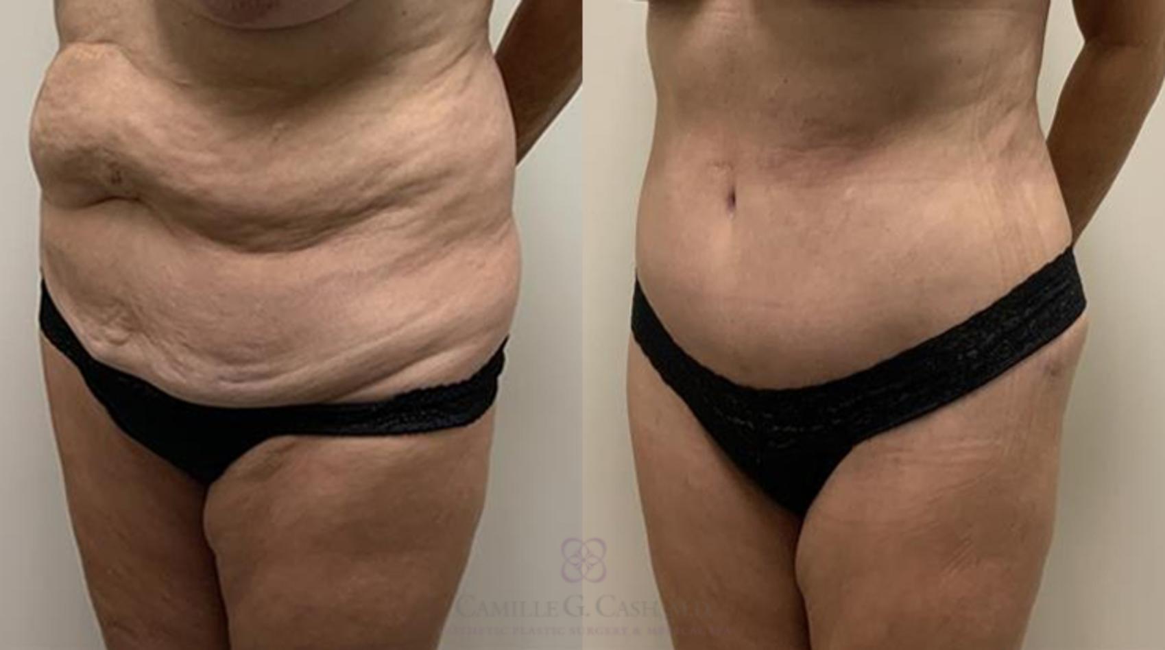 Before & After Tummy Tuck Case 364 View #3 View in Houston, TX
