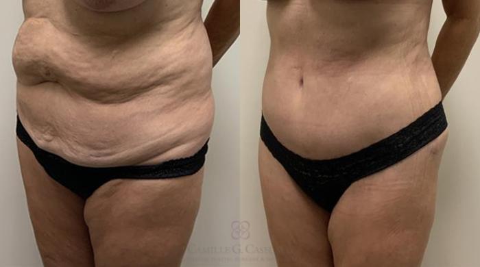 Before & After Tummy Tuck Case 364 View #3 View in Houston, TX