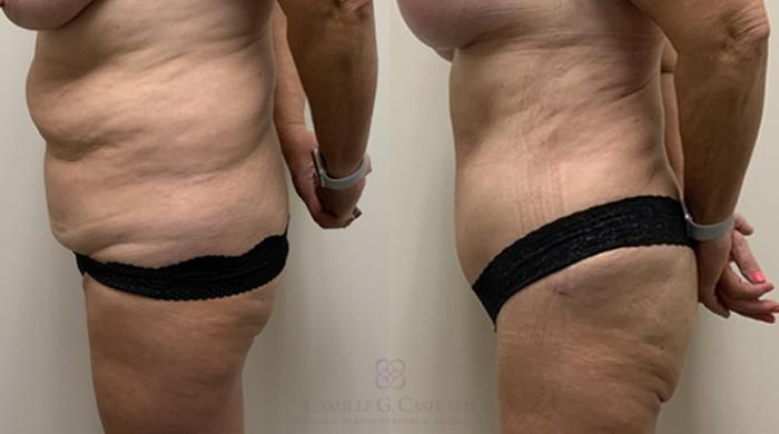 Before & After Tummy Tuck Case 364 View #4 View in Houston, TX