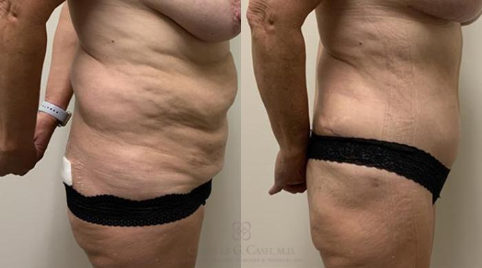 Before & After Tummy Tuck Case 364 View #5 View in Houston, TX