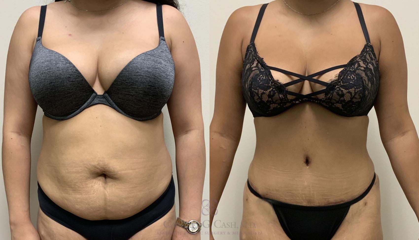 Before & After Tummy Tuck Case 385 View #1 View in Houston, TX
