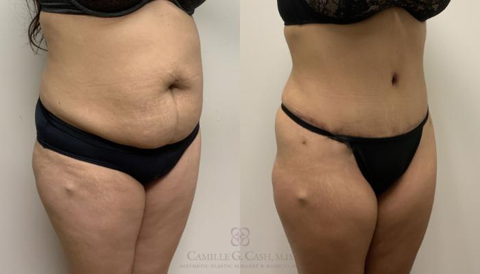 Before & After Tummy Tuck Case 385 View #2 View in Houston, TX