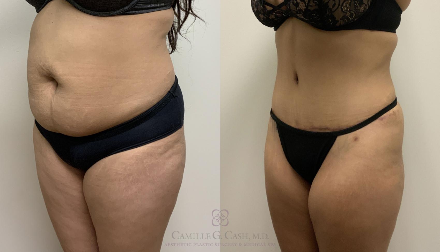 Before & After Tummy Tuck Case 385 View #3 View in Houston, TX