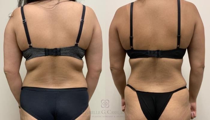 Before & After Tummy Tuck Case 385 View #4 View in Houston, TX