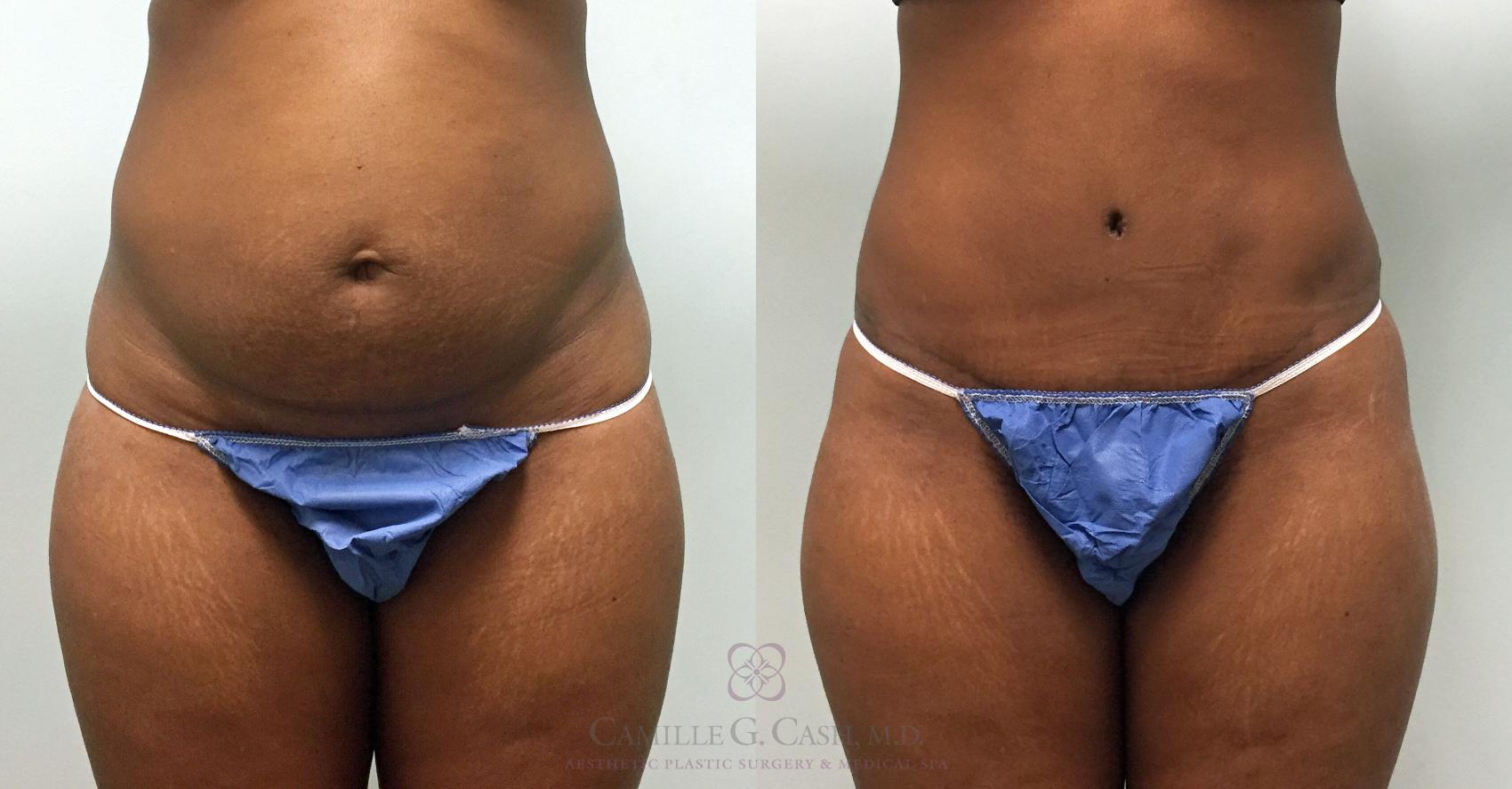 Before & After Tummy Tuck Case 391 View #1 View in Houston, TX