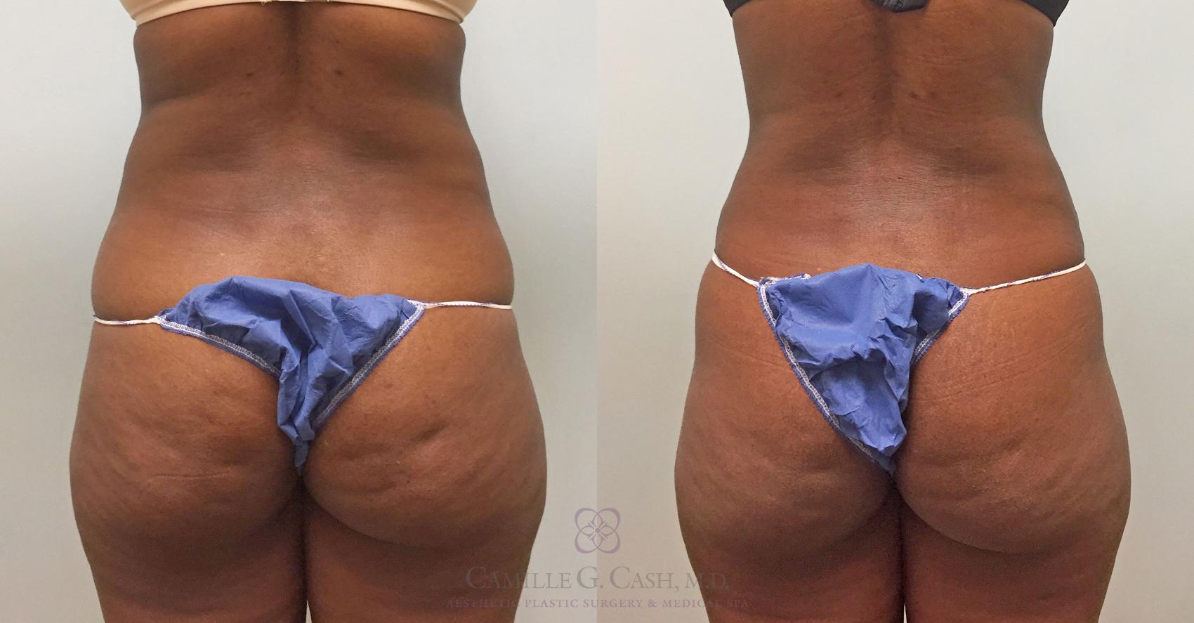 Before & After Tummy Tuck Case 391 View #2 View in Houston, TX