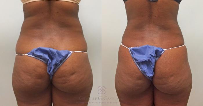 Before & After Tummy Tuck Case 391 View #2 View in Houston, TX