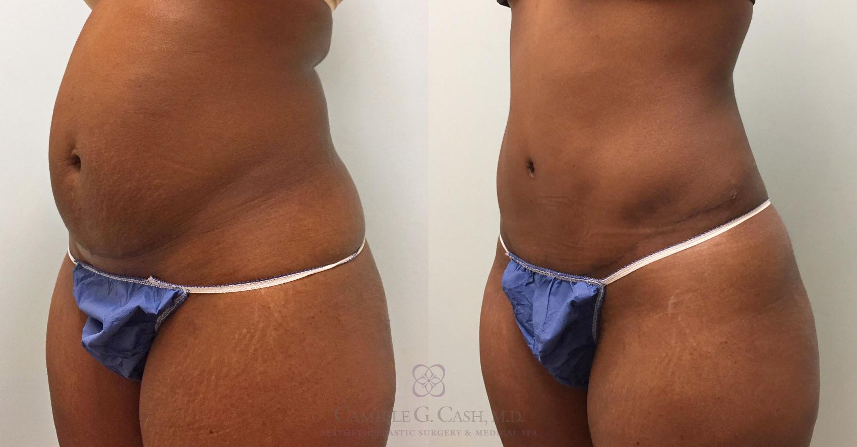 Before & After Tummy Tuck Case 391 View #3 View in Houston, TX