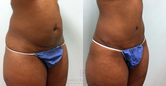 Before & After Tummy Tuck Case 391 View #4 View in Houston, TX