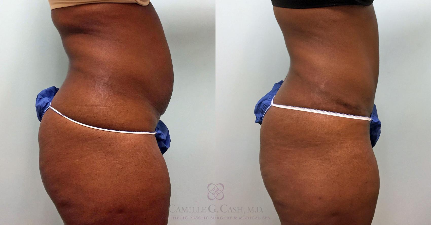 Before & After Tummy Tuck Case 391 View #5 View in Houston, TX
