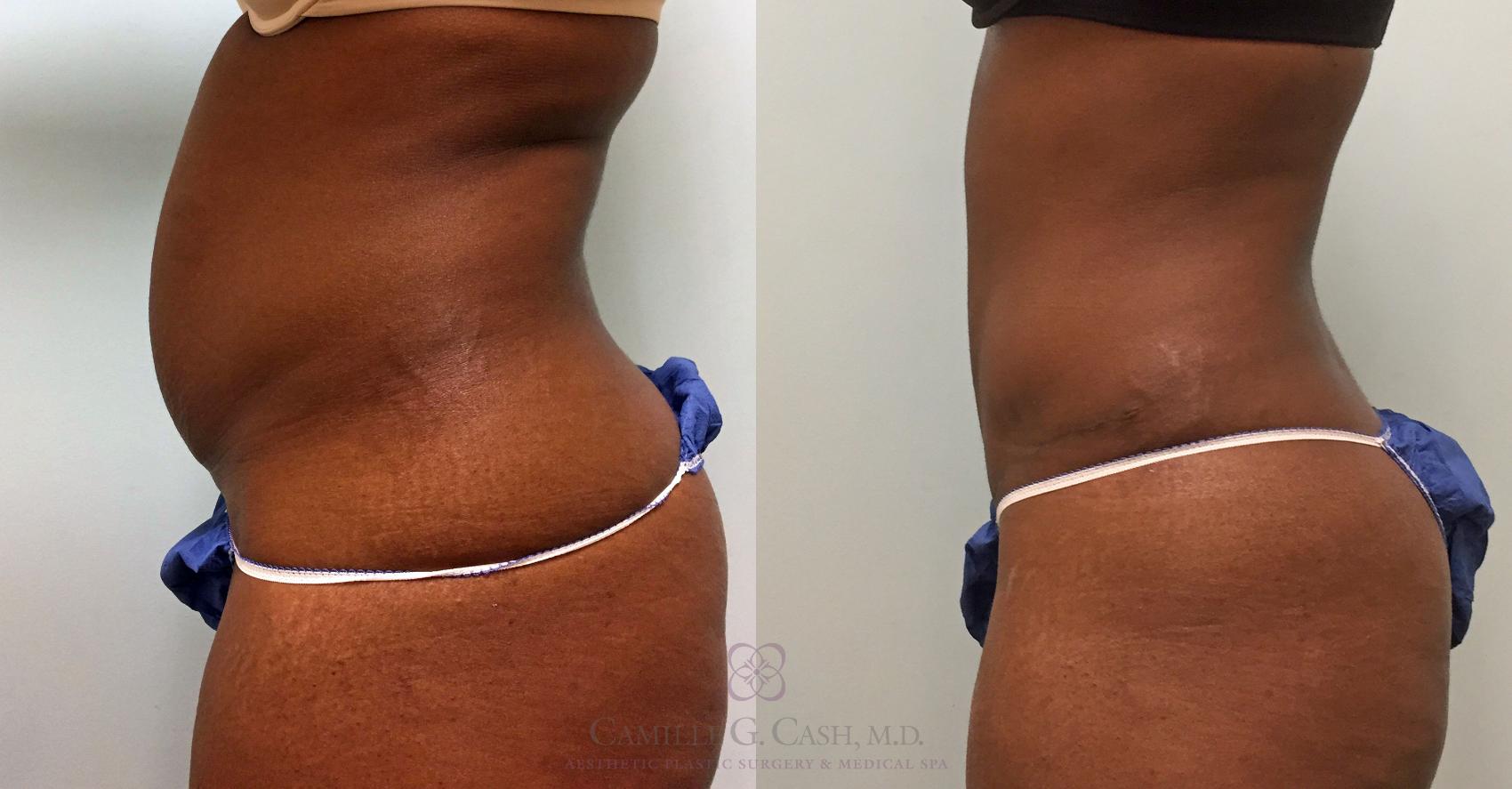 Before & After Tummy Tuck Case 391 View #6 View in Houston, TX