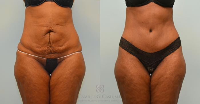 Before & After Tummy Tuck Case 395 View #1 View in Houston, TX