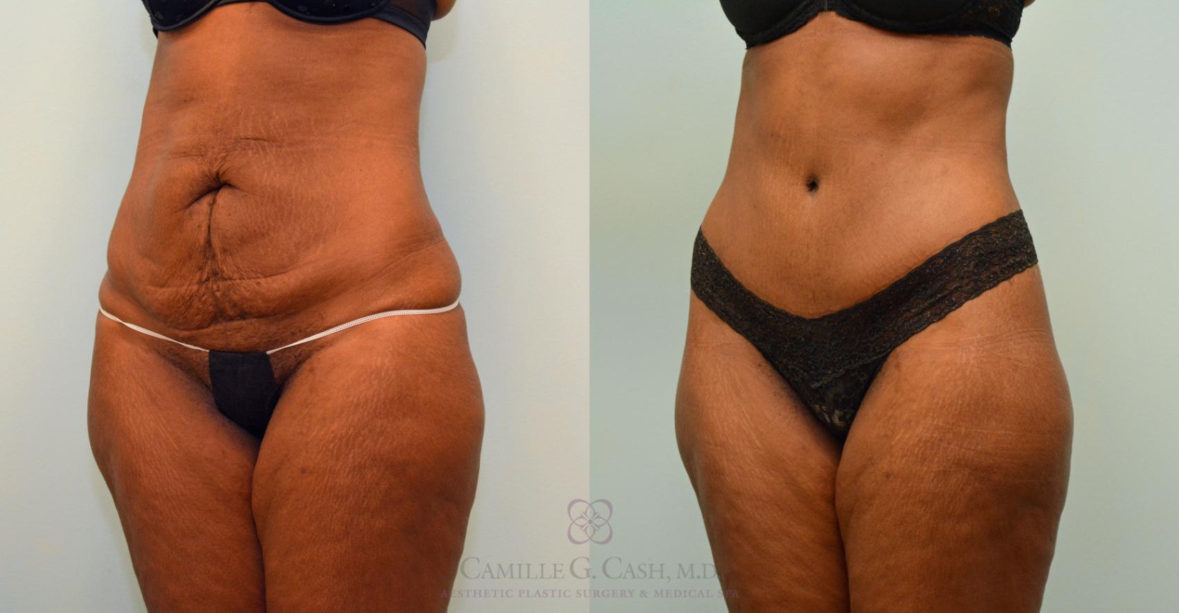 Before & After Tummy Tuck Case 395 View #2 View in Houston, TX