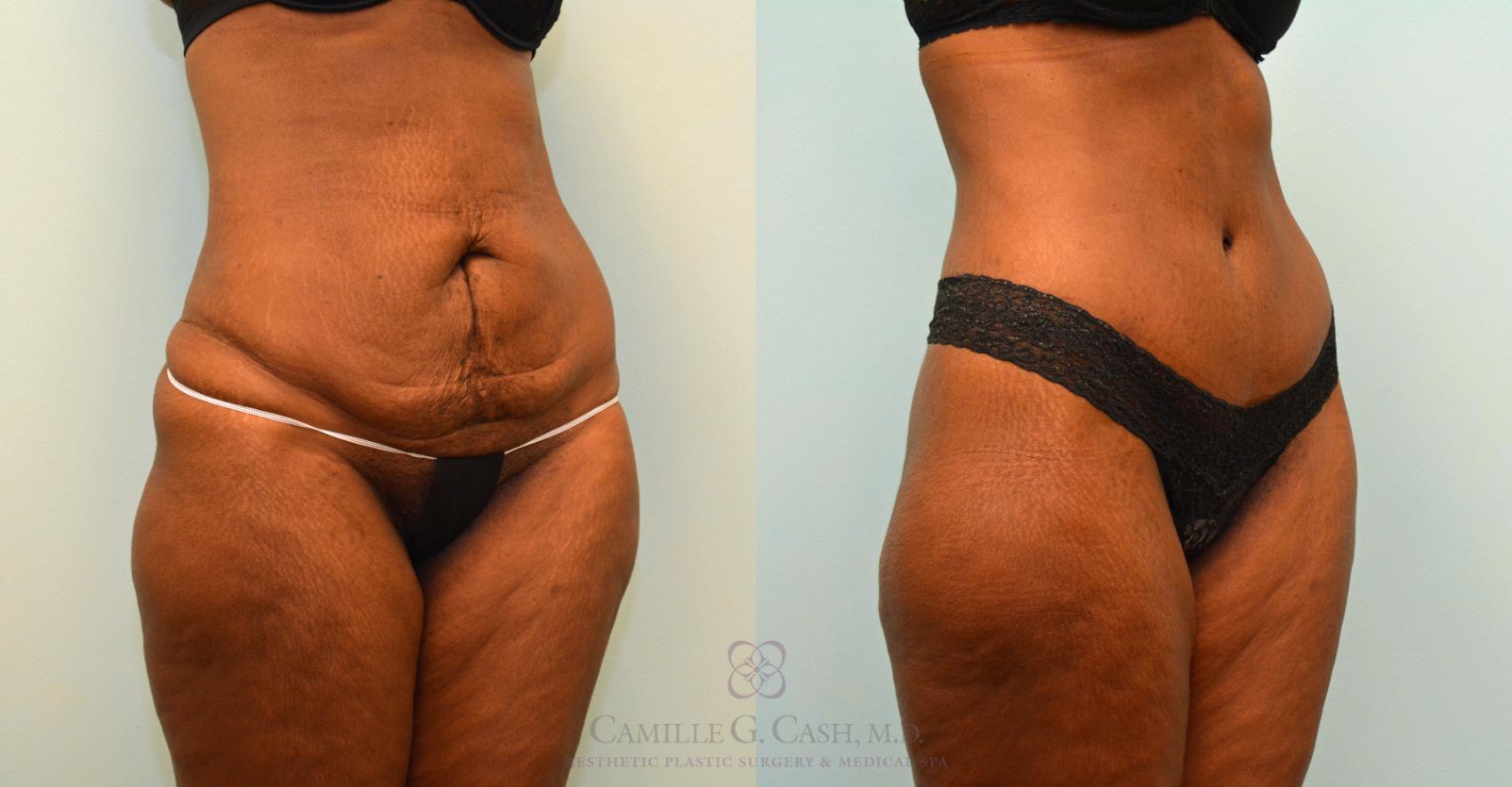 Before & After Tummy Tuck Case 395 View #3 View in Houston, TX